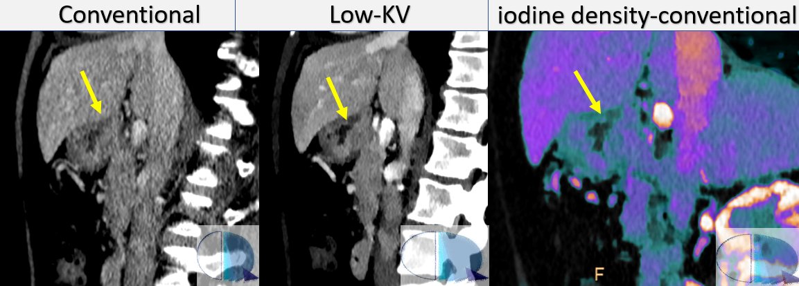 @CtSpectral Companion case seen the other day at @RMyTC_Rosario. Posterior gastric ulcer in a proven gastric neoplasm, better seen in the low-KV images and in the iodine overlay than on the conventional images. @eliseovano @CastellaccioDr #FOAMed #SpectralCT