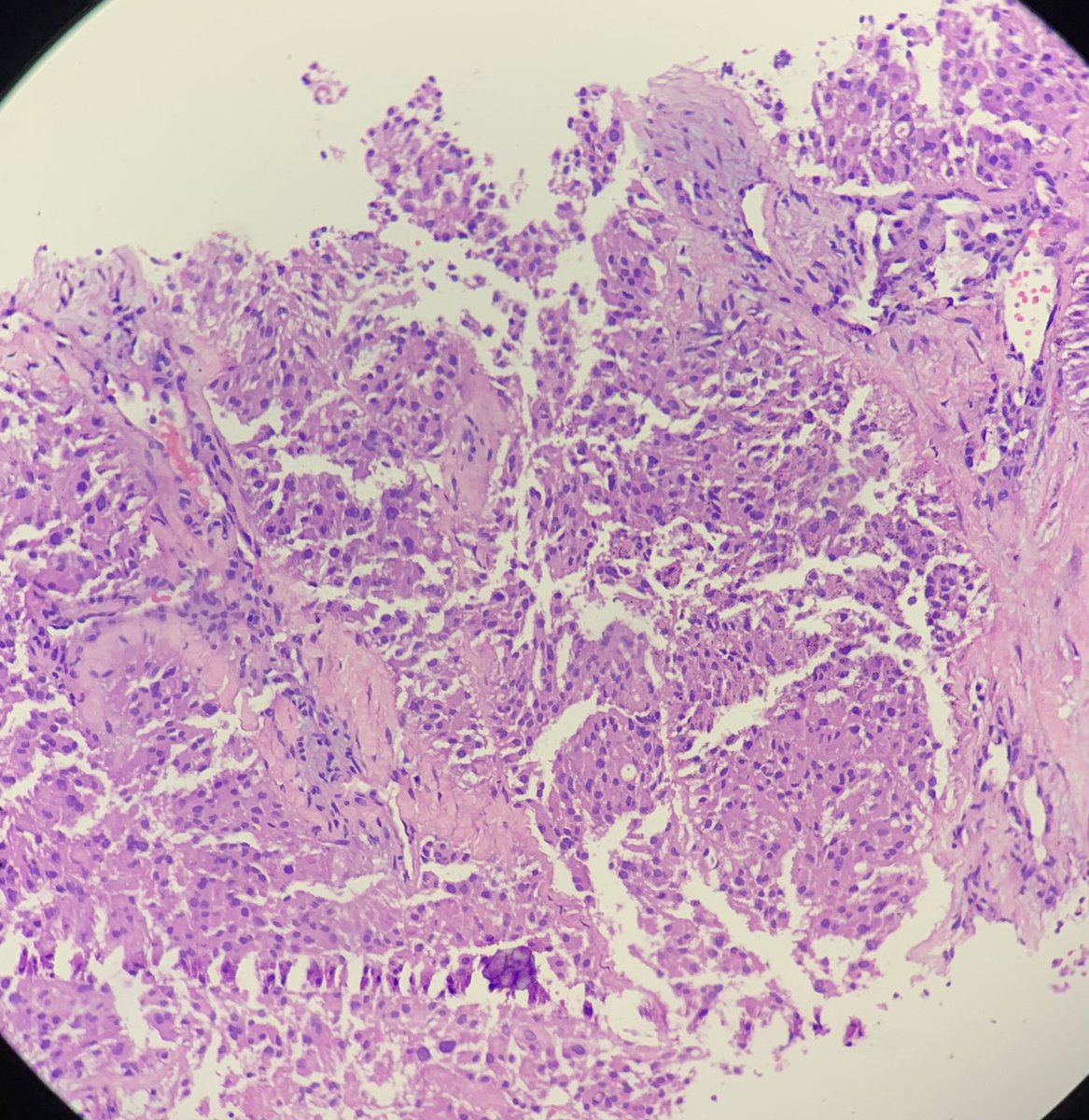 drparomitaroy's tweet photo. Core biopsy from a 4 cm liver mass, in a known case of low grade papillary urothelial carcinoma. 
CK7 strong diffuse positive, CK20, p63 negative, GATA3 stains rare cells. What is your diagnosis?  #unknownprimary #IHC https://t.co/7E0fY8WKcX