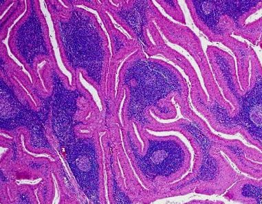 A quick review of salivary gland tumors 
A 70 year old man presented with submandibular mass.Excision was done and
histopathology shows the image. 
True regarding the condition is? #Histopathology  #pathology #pathtwitter #pathologymcq #pathologists #pathtweetorial #pathresidents