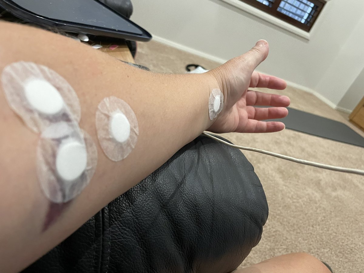 ProfSMcLaren's tweet photo. @docbenh Couldn’t agree more! The aftermath on the day and during the next week of three attempts by an anaesthetist. Started at my wrist and ended at my elbow. 🤬 https://t.co/RodSYfHL3X