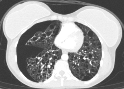 DulcichGonzalo's tweet photo. F35 with tuberous sclerosis. Lymphangioleiomyomatosis + pneumothorax + bilateral renal angiomyolipoma
Classic findings 📝
#radres #FOAMrad #radiology  #chestrad https://t.co/4W6u0QqZHX