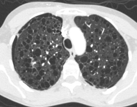 DulcichGonzalo's tweet photo. F35 with tuberous sclerosis. Lymphangioleiomyomatosis + pneumothorax + bilateral renal angiomyolipoma
Classic findings 📝
#radres #FOAMrad #radiology  #chestrad https://t.co/4W6u0QqZHX