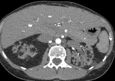 DulcichGonzalo's tweet photo. F35 with tuberous sclerosis. Lymphangioleiomyomatosis + pneumothorax + bilateral renal angiomyolipoma
Classic findings 📝
#radres #FOAMrad #radiology  #chestrad https://t.co/4W6u0QqZHX