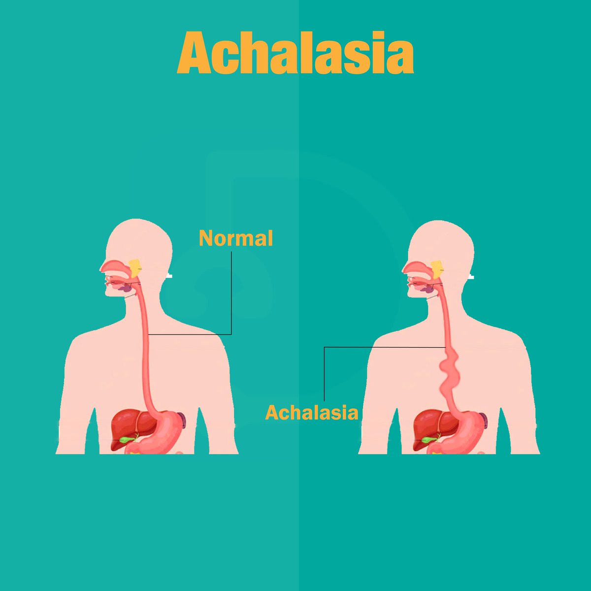 Docsteth1's tweet photo. The more stress we have, the less food we retain!
To know more about Achalasia click on the link
🔗https://t.co/2XKadPMqkv
#Achalasia #Achalasiasurvivor #Achalasiawarrior #Docsteth #DocstethPost #MedTwitter #MBBS #Healthcare #medicalprofessionals #healthcareprofessionals #med https://t.co/WAbCcrzdH7