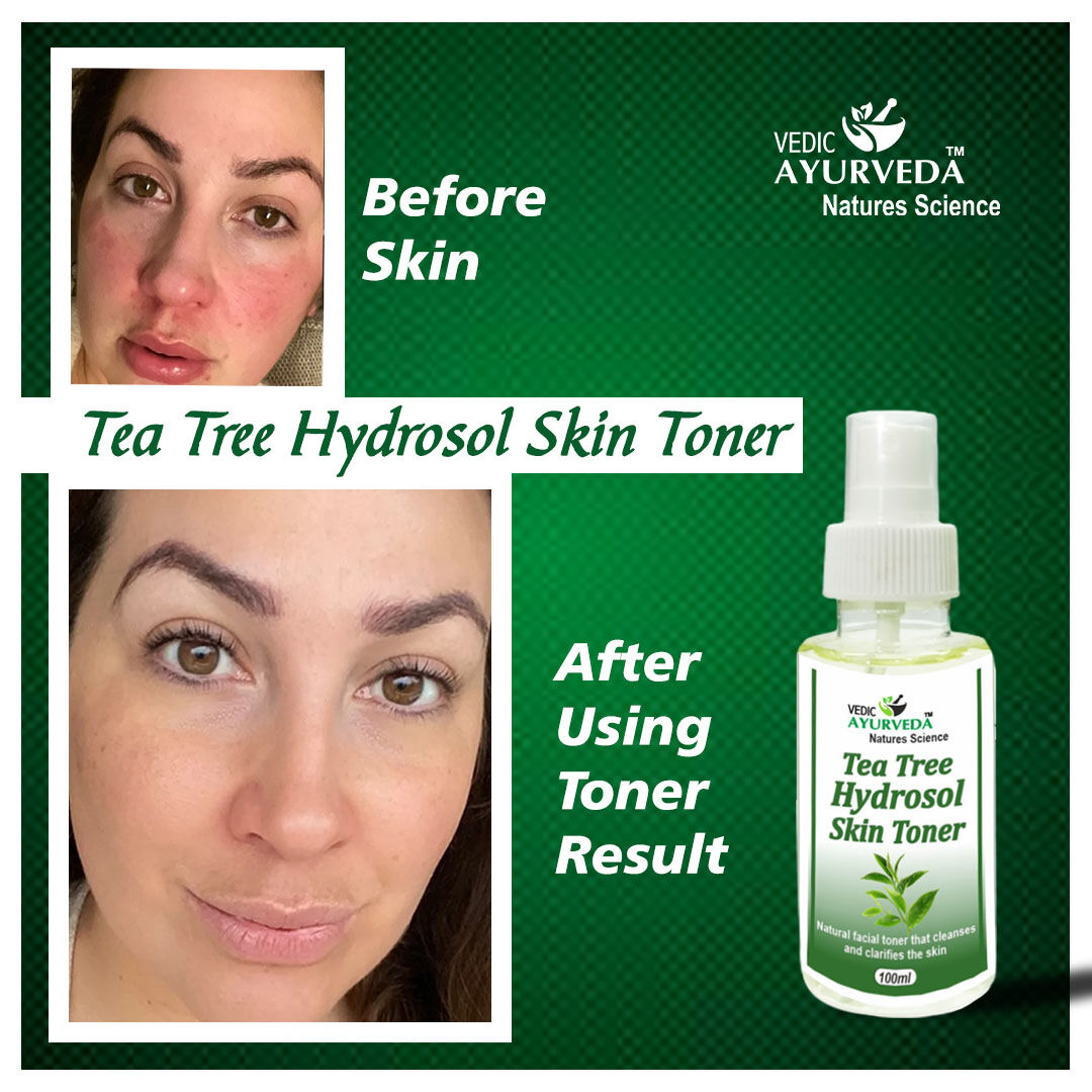 VedicAyurveda01's tweet photo. Tea Tree Hydrosol Skin Toner for Prevent Acne, Tightening and Rejuvenating your Skin
#teatree #hydrosol #skintoner #afterbefore #results #vedicayurveda #naturalscience
#Tightening #PreventAcne #Rejuvenating
https://t.co/valDpBEVAl https://t.co/WFtPMewdqV