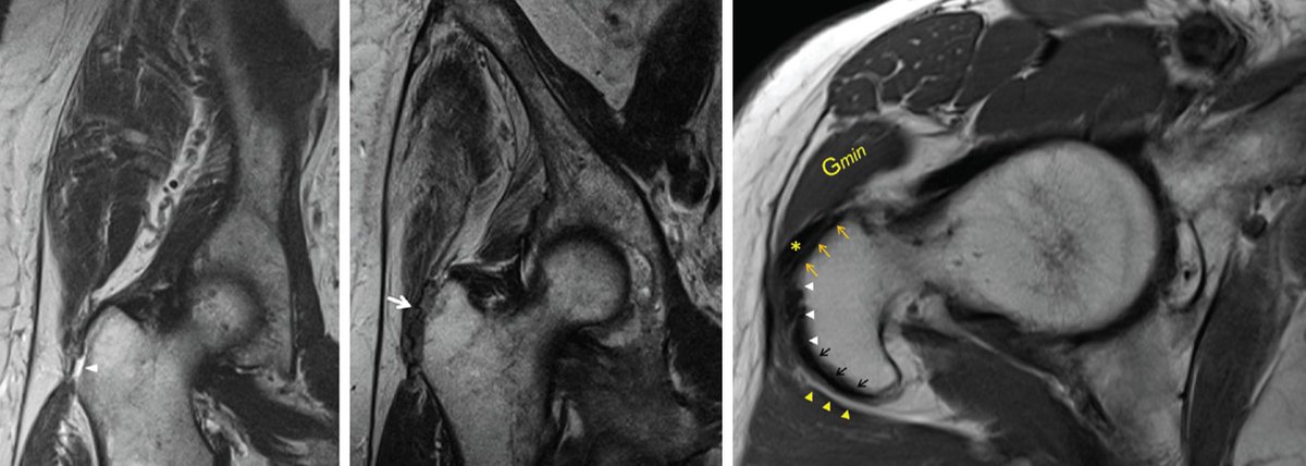 Check out our #OpenAccess study on #Hip Abductor Tendons: doi.org/10.1177/036354… in #AmJSportsMed.
Conservative treatment showed good outcomes, with low risk of progression or fatty muscle infiltration over 6 years. 
@derbalgrist │ @balgristcampus │ @UZH_en 
#MSKrad #MRI