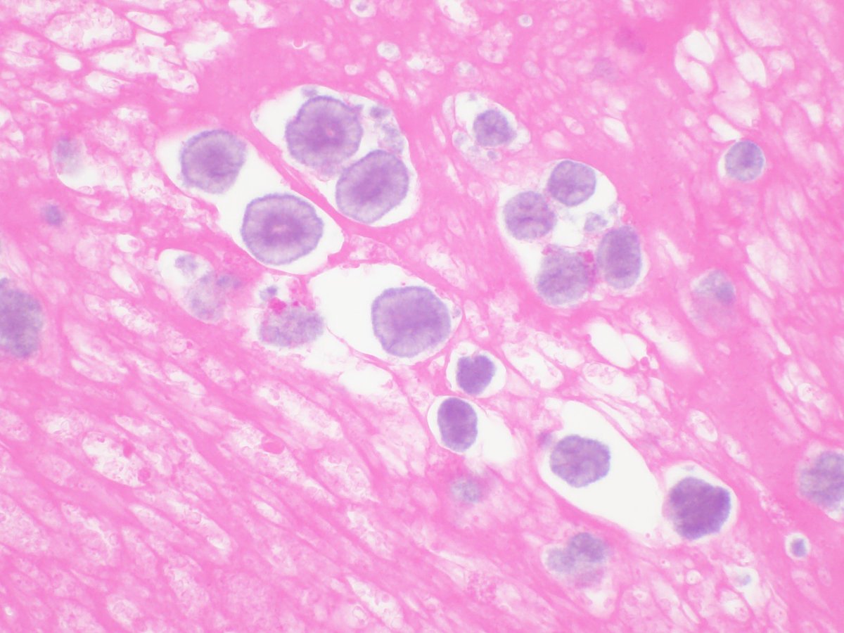 Abdominal wall seroma cytology showing acellular laminated structures with with radial cross striations. Non refractile and negative for special and ICC stains. Dx: Liesegang rings. Not to be mistaken for parasites #PathTwitter <a href="/cytopathology/">Cytopathology.org</a> <a href="/IACytology/">International Academy Cytology</a>