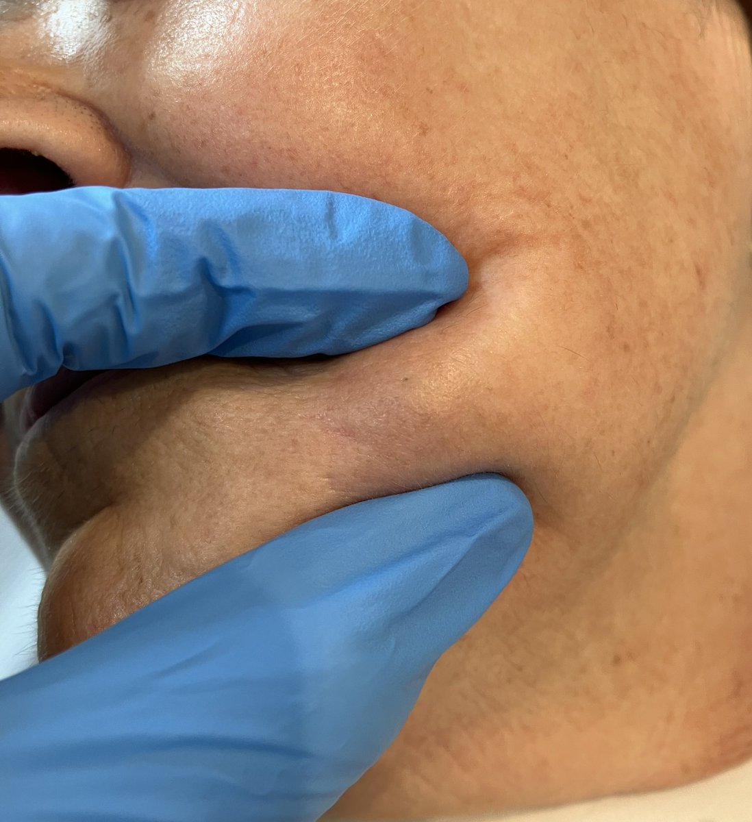 allobe86's tweet photo. La presencia de 1 o varios nódulos faciales,bien delimitados,en pacientes que se han infiltrado ácido hialurónico,nos obliga a preguntar por infección reciente por COVID o vacunación.

Se han descrito reacciones inflamatorias de estos rellenos tras la infección 

#dermatología https://t.co/Rii5Oo1fXW