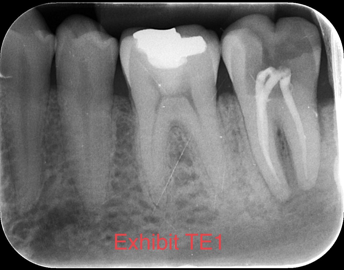 Talat2022E's tweet photo. Hello @GDC_UK Can you pls let me know if there is anything wrong with the attached X-ray where a RCT has been performed. I am getting mixed messages from 3 different dentists and don’t know who to believe and trust. @ColinCampbellFA @NHSEngland @NHSuk @LilianGreenwood @TheBDA https://t.co/msqg78pMMg