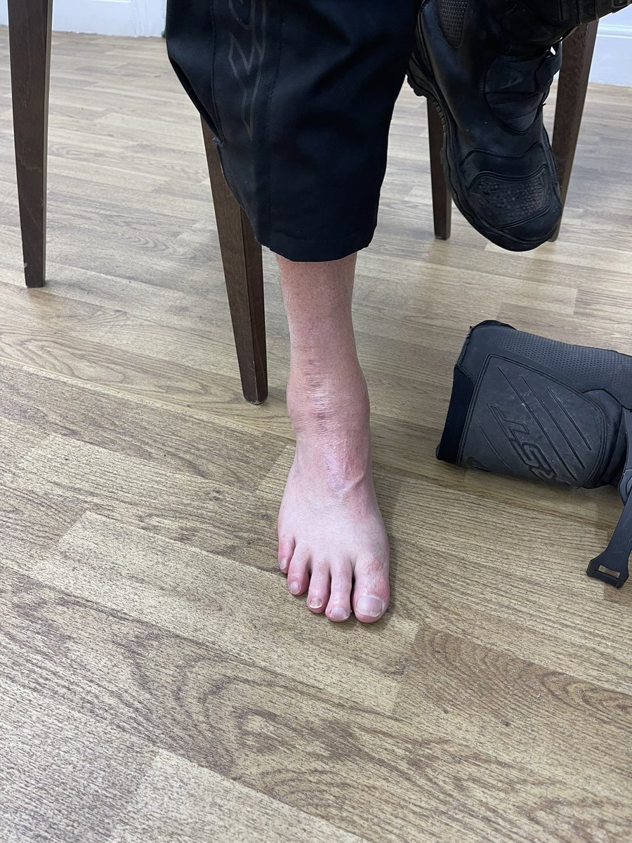 Yorkshire F&A Clinic @feet2knees (@yorfac) on Twitter photo Sad. My penultimate <a href="/corintechnology/">Corin Group</a> Zenith ankle replacement last week.
My last one next week.
#MDR is having a big impact on implants & industry.
Used correctly the Zenith is a very good implant. See here varus OA. 2 yrs out. With consent. Sad. My penultimate <a href="/corintechnology/">Corin Group</a> Zenith ankle replacement last week.
My last one next week.
#MDR is having a big impact on implants & industry.
Used correctly the Zenith is a very good implant. See here varus OA. 2 yrs out. With consent.