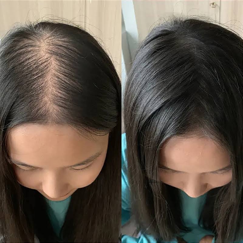 erzxzh's tweet photo. Review ni serious tak tipu. Mantap wey shampoo ni, kat review hampir semua yee share before &amp; after pakai shampoo ni. Memang semua pakat share dengan rambut baru 😂 Yang dah nyaris nak botak tu boleh cuba 🤭 https://t.co/pFi0Tl8Cb8