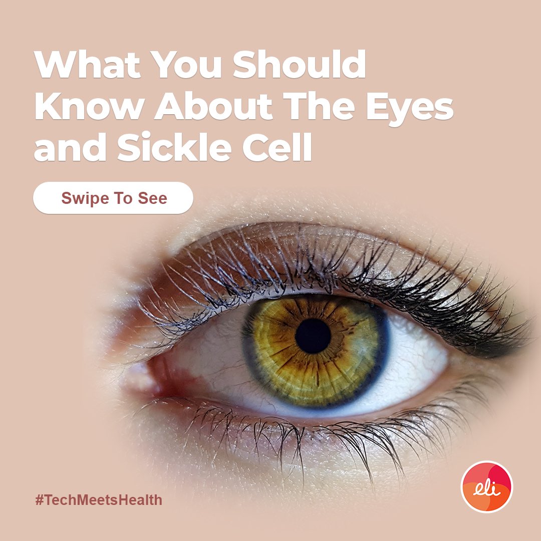 What you should know about the eyes and sickle cell: some insight on Sickle Cell Retinopathy. Swipe for more insight.

A thread.👇🏽

#TheEliApp #TechMeetsHealth #LivingWithSickleCell #MedicalCare #SickleCellApp #SShemoglobin #SChemoglobin #EyeCare #Retinopathy #Ophthalmology