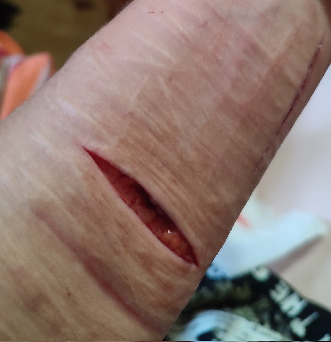 clairokals's tweet photo. tw sh 
fake 
cut vs closed 
bloodtwt cutwt beantwt fasciattwt styrotwt raspberryfillingtwt 988twt ouchietwt bandaidtwt https://t.co/3tYLIIfzd1