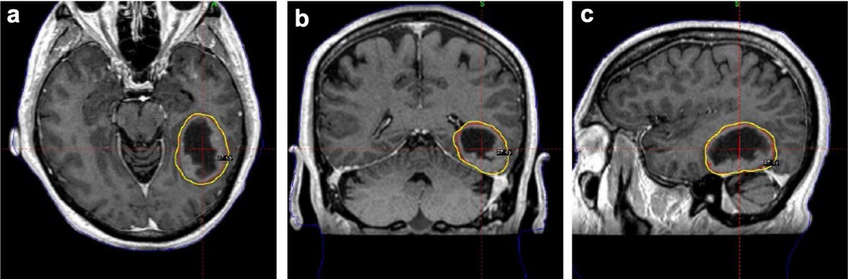 Journal of Neuro-Oncology tweet media