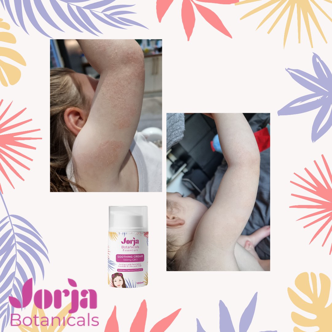 JorjaBotanicals's tweet photo. Check out our very own Jorja's results using the Soothing Cream to clear up her eczema - the 2 photos are just 48 hours apart! 💕 https://t.co/zgEuacvPNe