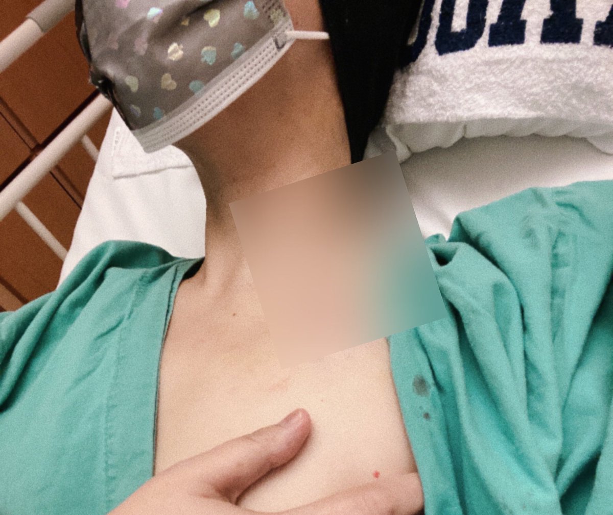 金曜の夕方にCVポート設置手術は無事完了しました🤖

術跡は一応自主規制⚠️

右腕(利き手)に点滴針が刺さってて、なかなか浮上しづらい今入院🥺
丁寧な返信ができないジレンマ抱えてたりします😔

ごめんなさい💦&amp;いつもありがとうございます😻