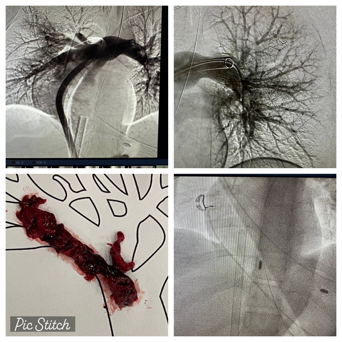 In light of the thanksgiving spirit. Thankful for the privilege to care for our patients.
24 yo F, 1 month postpartum, massive PE. S/p tPA on 4 pressors, SBP 70s,intubated,sat 60%.
Emergent VA ECMO, pulm thrombectomy. Walks out of the hospital w her beautiful daughter week later