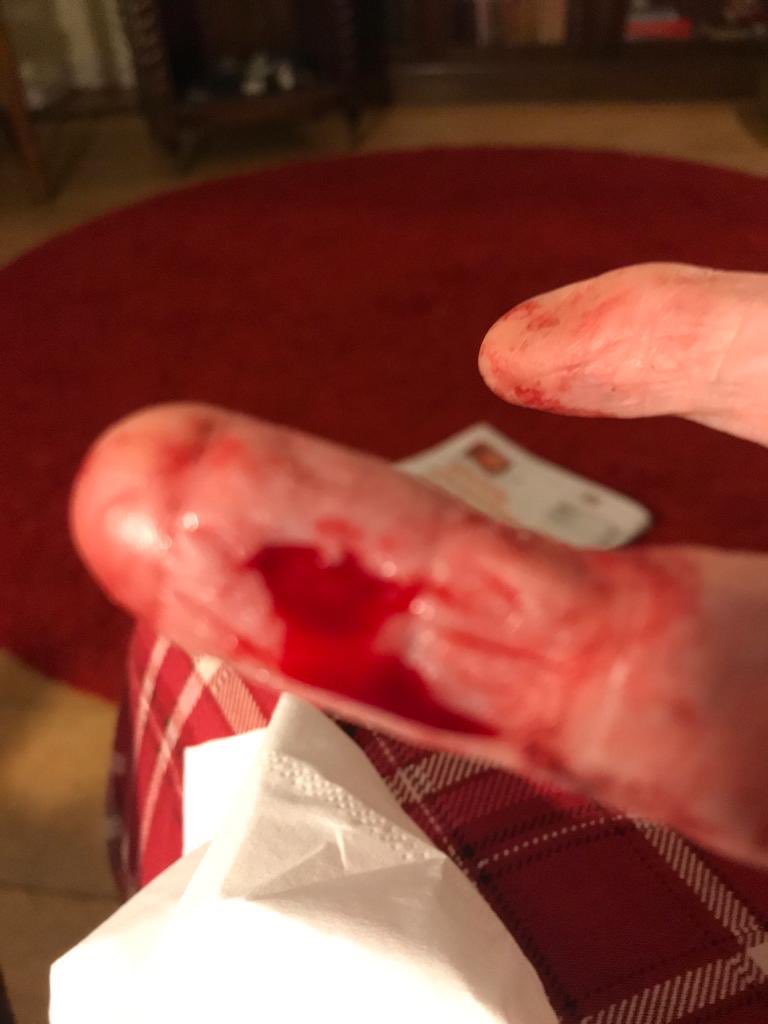 SarahBeer4's tweet photo. @UKjdspoons this happened to my mum in one of your pubs today when she tried to pull her chair in!!! https://t.co/amrMXry7kn