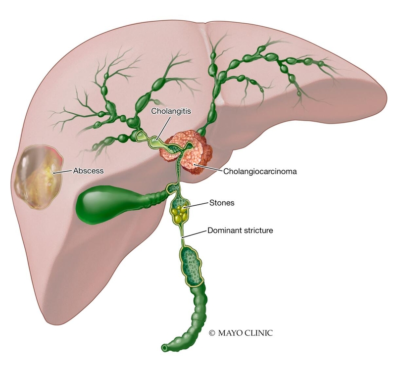 Mayo Clinic Comprehensive Cancer Center on Twitter "Jaundice, white