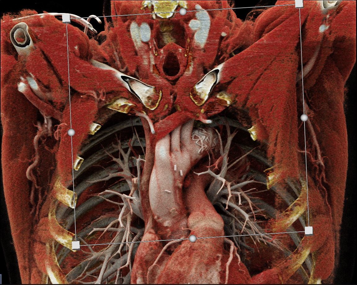 Cinematic Rendering -- making CT scans look like anatomy - now there is a wild concept. @ISEVSonline @VascularSVS @VEITHsymposium @Blearning @VSGBI @VascularSpecia4 @VascularOnline @farkomd @vasculargirl