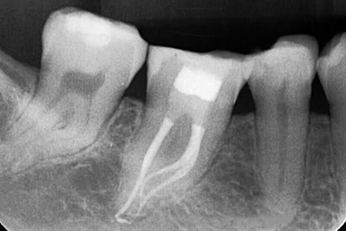 OMDENTALCLINICS's tweet photo. we are specialised for single visit implantation and single visit ro ..For more info visit...https://t.co/hXxxA6NEu3 https://t.co/WRJgC5kW19
