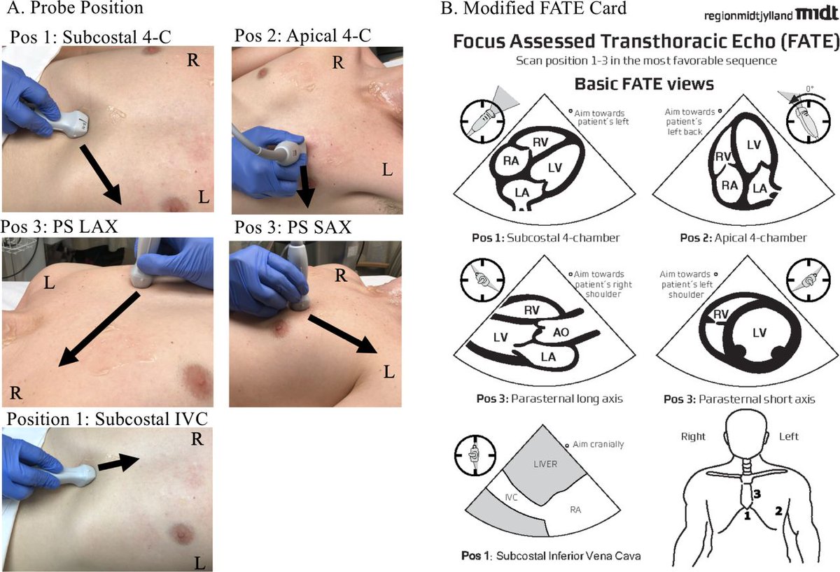 POCUSIAPN's tweet photo. Probe placement for focused cardiac #ultrasound examination + modified basic FATE card. 
Click ‘ALT’ for abbreviations 
Courtesy: 🔗 https://t.co/Xd32f7c4lG
#POCUS #MedEd #FOAMed #Nephpearls #IMPOCUS https://t.co/WCwdsmlIAX
