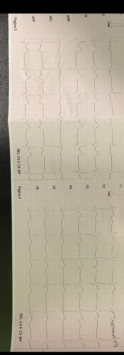 csmolinamazon80's tweet photo. Hombre de 38 años sin AP de interés, con dolor torácico 5h de evolución. EKG supradesnivel cara inferior y ecocardioscopia aquinesia inferobasal e hipoquinesia lat mediobasal. FEVI ok. Código IAM: ICP con enf 3v, oclusión trombótica Cx media.
#ecocardio #codigoIAM #sem #svae https://t.co/kRjqyW0Qg2