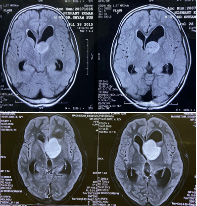 ClinicalOncol13's tweet photo. #Pilocytic_Astrocytoma is a low-grade benign #tumor that rarely spread along the #neuraxis. In this report, we described our experience with a cranial pilocytic astrocytoma in a 14-year-old child
Visit us: https://t.co/lgwPcnY9Zg https://t.co/NvwLSJopqE