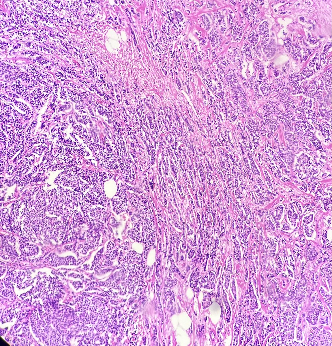 Praachy27's tweet photo. IDC ( upper right corner) with NET( lower left corner) showing strong Synaptophysin positivity- not so common hybrid. #crittersontwitter #educationalpathtweetaward #APCON2022 #APCON2022PathTweetAward @DrAnilaSharma1 @archibhat3 @padmapathology1 https://t.co/zm3Y29xzTX