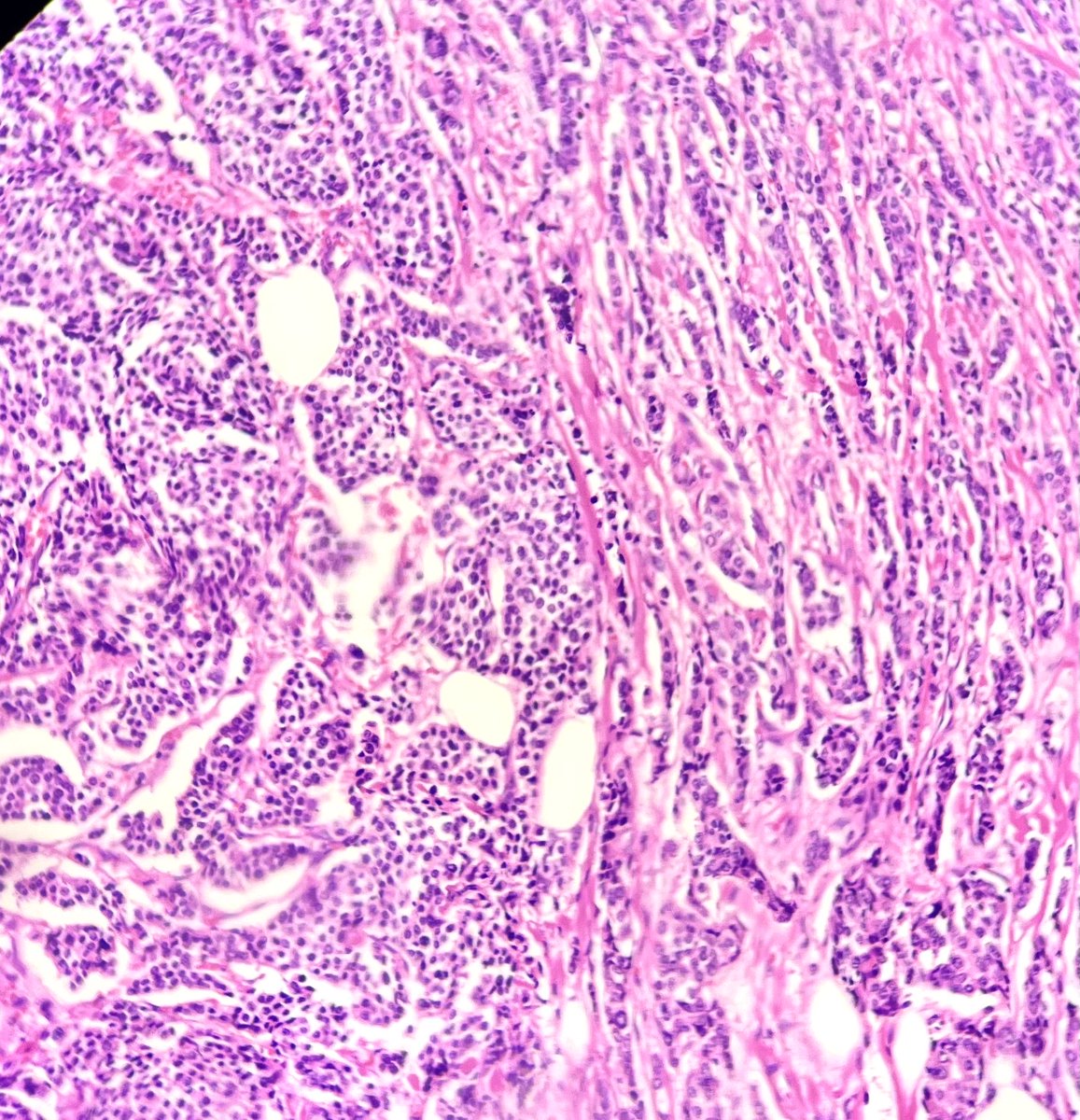 Praachy27's tweet photo. IDC ( upper right corner) with NET( lower left corner) showing strong Synaptophysin positivity- not so common hybrid. #crittersontwitter #educationalpathtweetaward #APCON2022 #APCON2022PathTweetAward @DrAnilaSharma1 @archibhat3 @padmapathology1 https://t.co/zm3Y29xzTX