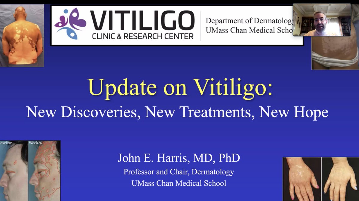 UMass Chan Department of Dermatology (@umassderm) on Twitter photo Our Department Chair, <a href="/HarrisVitiligo/">John E. Harris, MD, PhD</a> participated in <a href="/vitiligosociety/">Vitiligo Society</a>'s Vitiligo Society 2022 Research Summit this morning, presenting an update on #vitiligo, new discoveries, new treatments, and new hope! Our Department Chair, <a href="/HarrisVitiligo/">John E. Harris, MD, PhD</a> participated in <a href="/vitiligosociety/">Vitiligo Society</a>'s Vitiligo Society 2022 Research Summit this morning, presenting an update on #vitiligo, new discoveries, new treatments, and new hope!