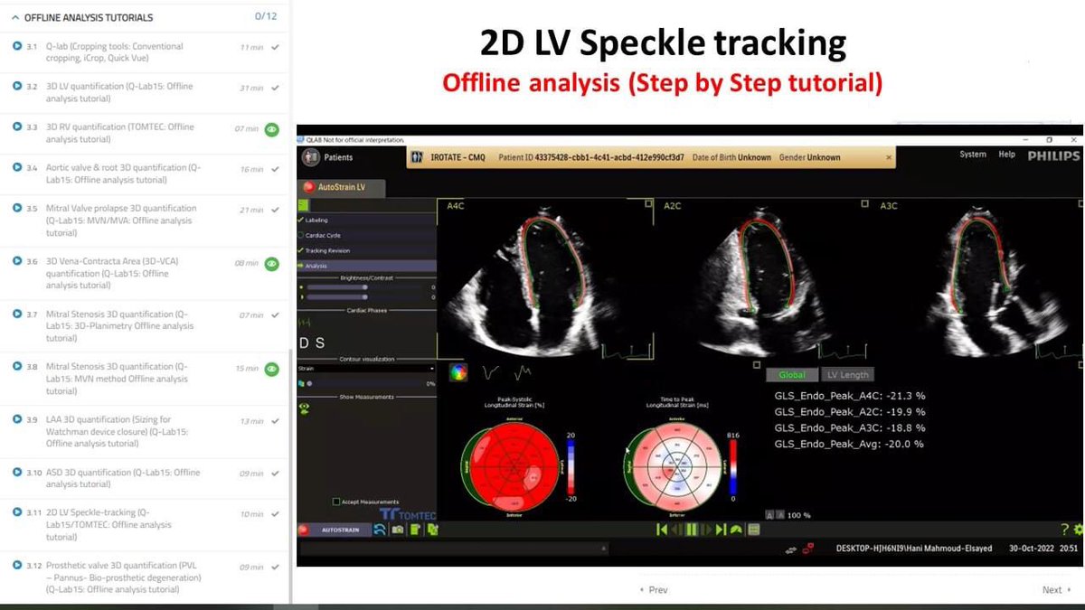 DrHaniMahmoud's tweet photo. The CIC Online Advanced Echocardiography Course

From basics to Advanced Trans-Esophageal Echocardiography, 3D-TEE, Speckle tracking, Interventional TEE in the cath-lab

30 lectures, recorded, watch them on-demand

For registration:
https://t.co/TMqQI7TvJ3 https://t.co/4WKkUbKjwI