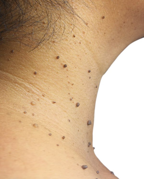DrKayumba's tweet photo. Ces excroissances de la peau communément appelées SKIN TAG  peuvent être un signe d’alerte que vous êtes en état d’insulino-resistance, de pré-diabete ou tout simplement de diabète.
Consultez votre médecin pour des prises sanguins d’hémoglobine glyquée. https://t.co/jrU3aGe623