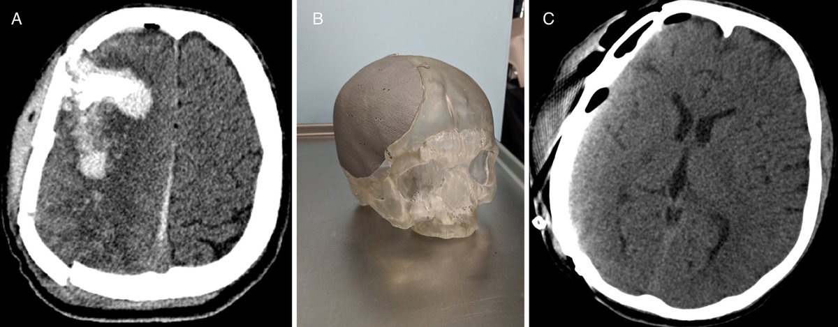 #OnlineFirst: Cranioplasty in the deployed environment: experience for host-country nationals thejns.org/view/journals/…