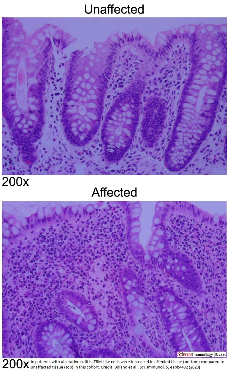 Science Immunology (@sciimmunology) on Twitter photo Read up on how <a href="/UCSDChangLab/">John Chang</a> <a href="/yeo_lab/">Gene Yeo’s Lab at UC San Diego</a> in 2020 combined multiple next-generation #genetic sequencing technologies to extensively characterize the array of cells and cellular components that contribute to ulcerative #colitis. scim.ag/Fp Read up on how <a href="/UCSDChangLab/">John Chang</a> <a href="/yeo_lab/">Gene Yeo’s Lab at UC San Diego</a> in 2020 combined multiple next-generation #genetic sequencing technologies to extensively characterize the array of cells and cellular components that contribute to ulcerative #colitis. scim.ag/Fp