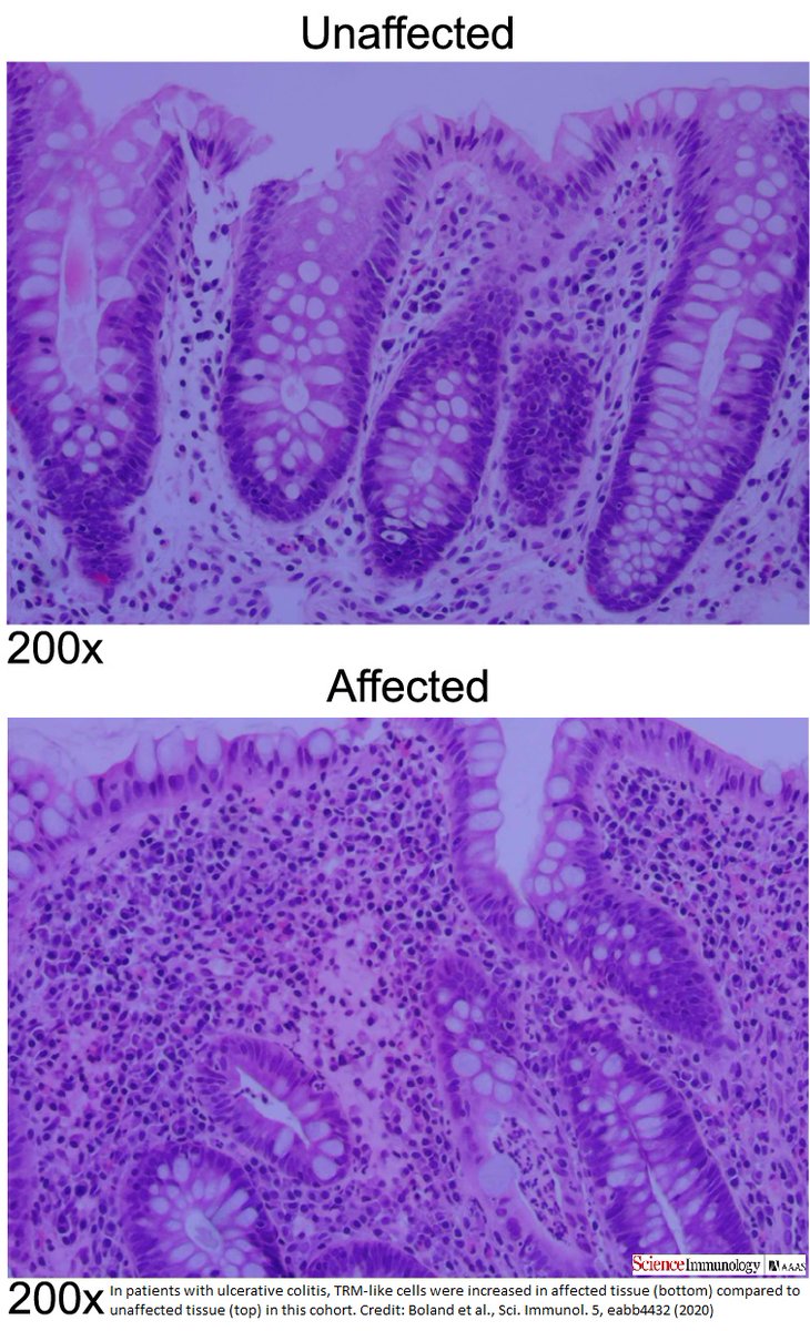 Read up on how @UCSDChangLab @yeo_lab in 2020 combined multiple next-generation #genetic sequencing technologies to extensively characterize the array of cells and cellular components that contribute to ulcerative #colitis. scim.ag/Fp