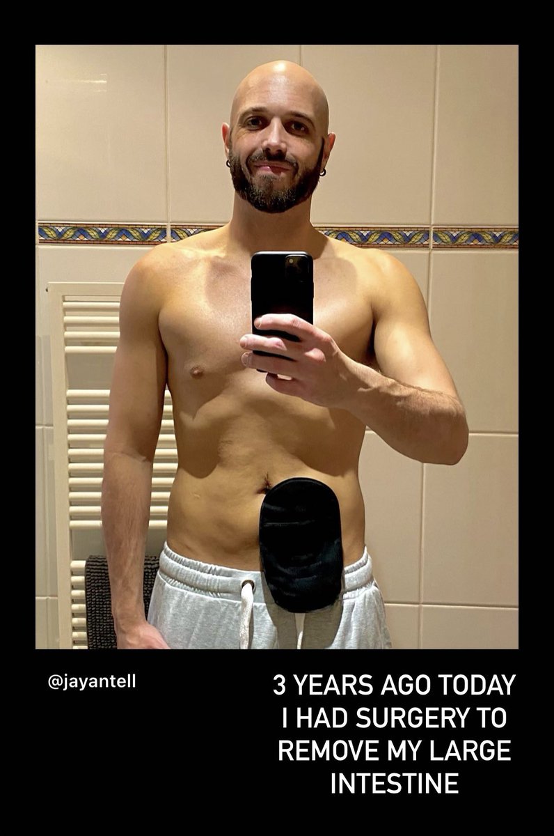 Jay_Antell's tweet photo. #3year #anniversary #positive #surgery #bag #ileostomy #ileostomylife #ileostomybag #stoma #stomabag #colitis #colitiswarrior #crohnsandcolitis #idb #idbawareness #ostomy #ostomyawareness #invisibleillness #invisbledisability #strong #crohns #saltshealthcare #bodypositive https://t.co/vRZPzNbFxI
