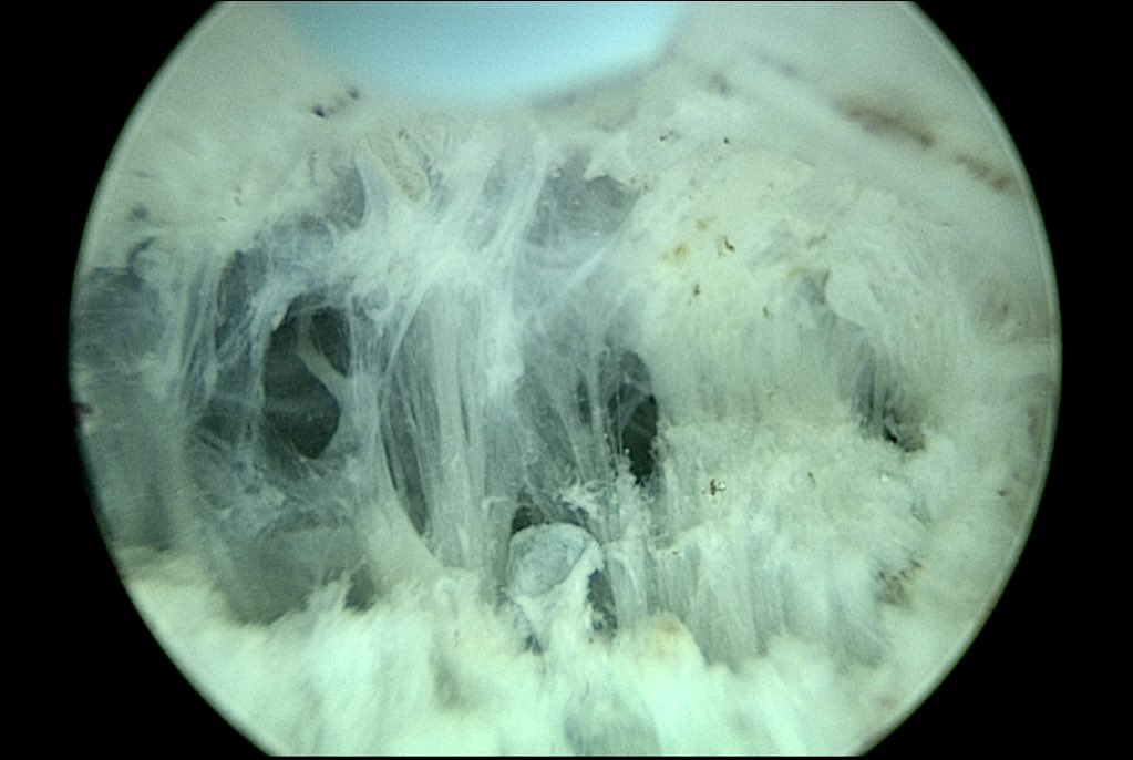 drtevaho's tweet photo. Vertical fibres just before reaching the bladder anteriorly during en bloc #HoLEP. A useful anatomical landmark never appreciated before en bloc #AEEP. These pictures show layer by layer from 1st appearance to entering the bladder. 1st described by @fgomsan #VeilOfFernando https://t.co/NXd5IWoqfo