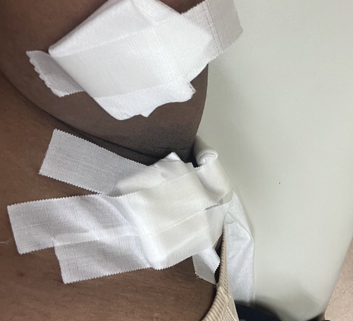 _Starsabreep's tweet photo. I used dove spray on deodorant and it gave me this weird cyst. Thought it was maybe an ingrown hair but everyday it would just get bigger &amp; more painful so I came to the ER and they literally had to cut it open or it would’ve eventually got in my blood stream?? I hate everyone https://t.co/qGPiU4tXGE