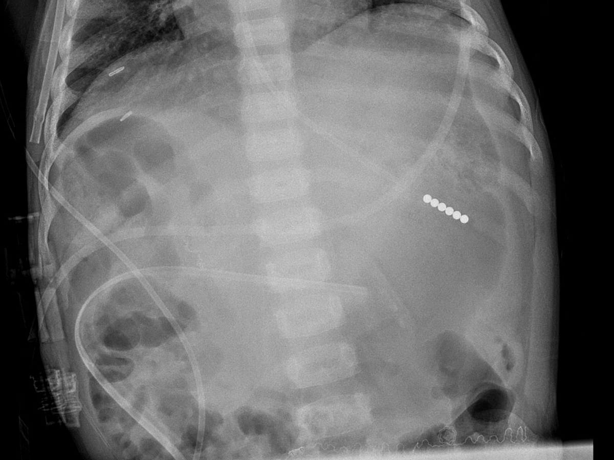 FariaLuisaL's tweet photo. 4-year-old girl with chronic renal failure.
Primary oxalosis

@CasesCookyJar companion case #85

#CookyBites #RGphx #PedRad #RadRes
@cookyscan1 https://t.co/NKc035MDAk