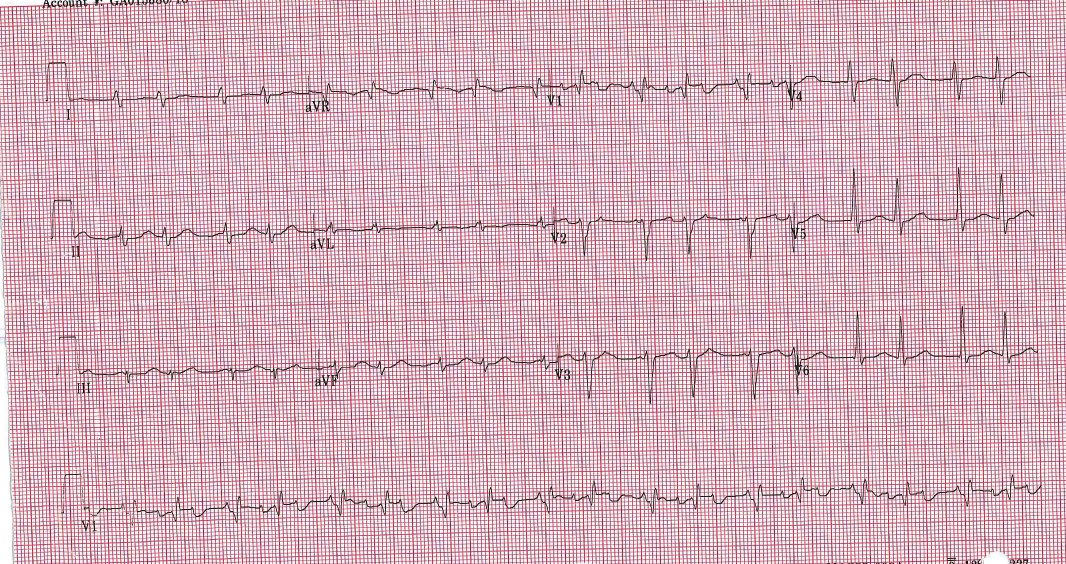 Likely mechanism of this arrhythmia?
#EPeeps #Cardiologyfellows 
@EPeeps_Bot