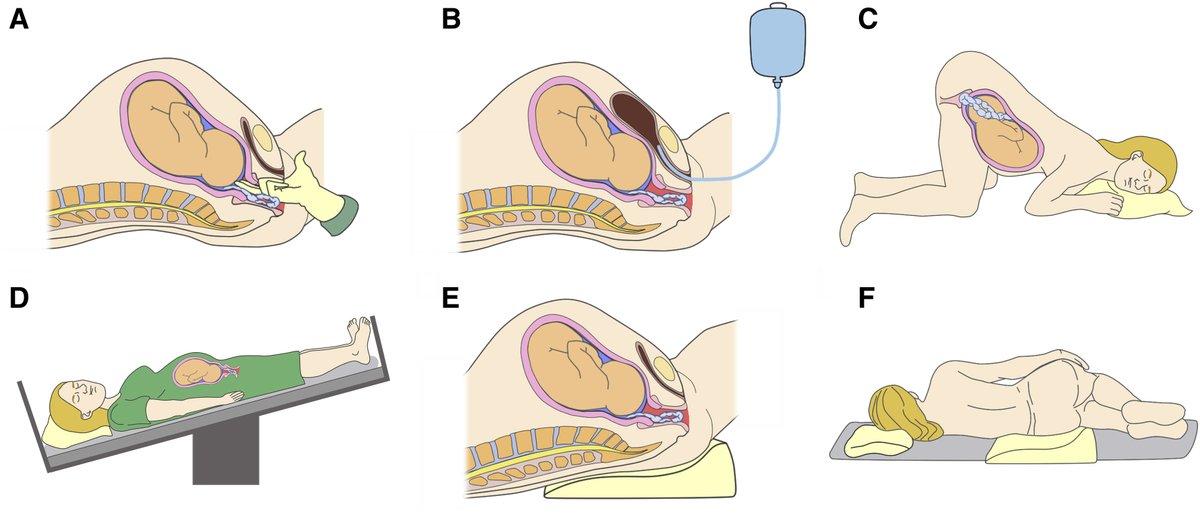 AJOG Expert Review:   Umbilical cord prolapse: revisiting its definition and management ow.ly/gqQX50LObZe