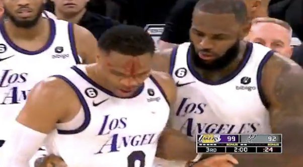 TimeoutSPORTS3's tweet image. Russell Westbrook is leaking due to a hard foul by Zach Collins 😮 

#Lakers