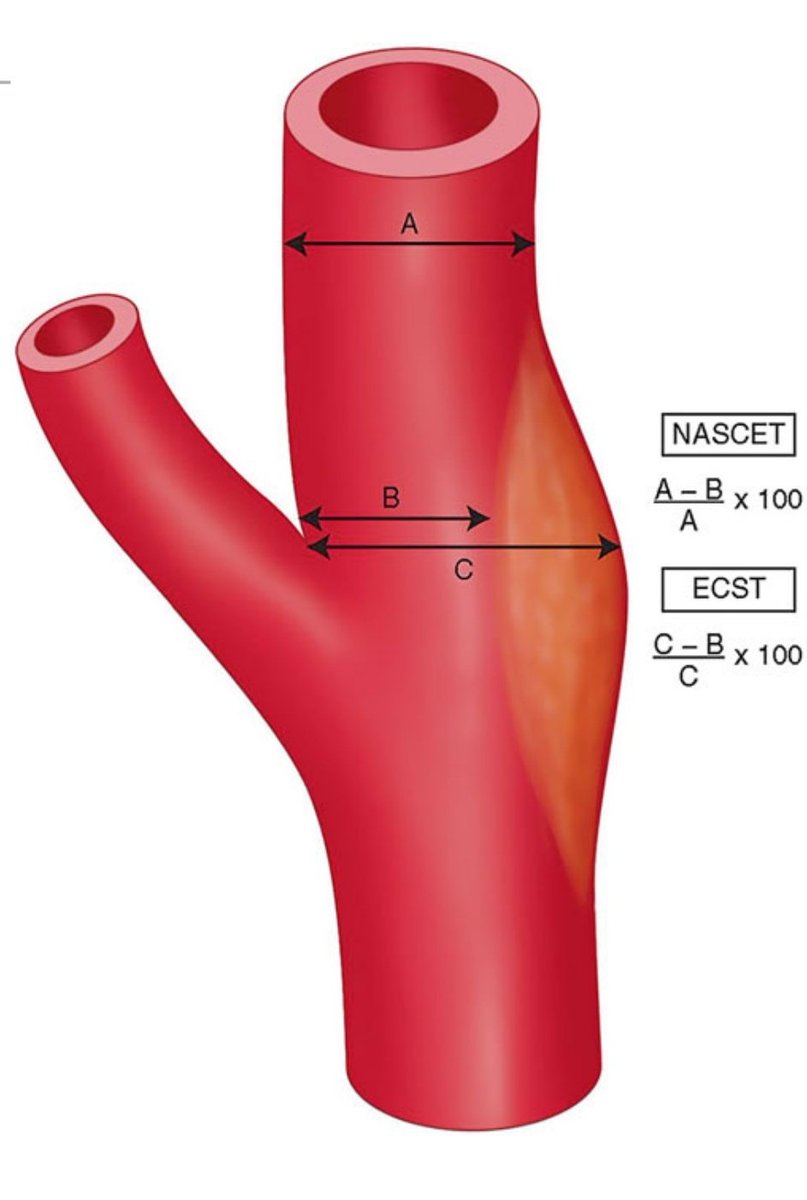 StrokeCliTrials's tweet photo. Measurement of internal carotid stenosis (%), per the NASCET and ECST trials. https://t.co/0Xhk4p6dbv