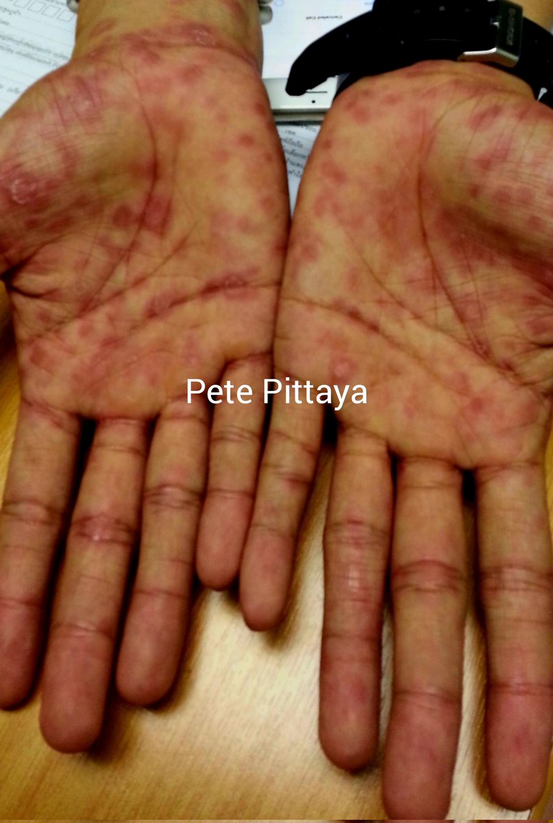 Pete Pittaya tweet media