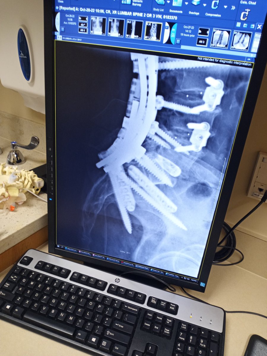 SOSUEME4what's tweet photo. @dbongino Hi Dan B,  take a look 2 years ago I  had back surgery , started with 2 rods and 26 screws and pins just 3 weeks ago I have 4 rods. I  was a combat field medic, and a Phlebotomist  and now Phlebotomist Mobil. I  know what you are getting ready for prayers and fast healing . https://t.co/L3UaIqeSlP