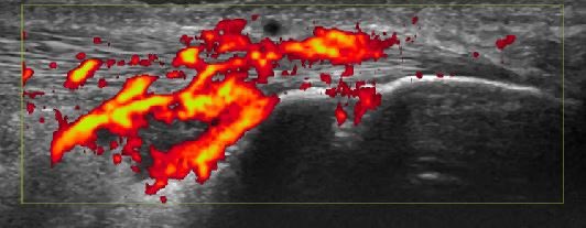 A classic image of inflammatory enthesitis in a patient with Psoriatic Arthritis, with a rare but very specific finding: erosion with positive power doppler #PsA #psoriaticarthritis #Spondyloarthritis #MSKUS