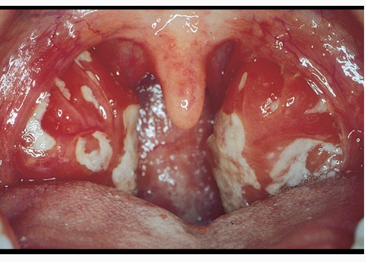 A 15-year-old girl p/w fever &amp; sore throat. She had recently gone to an outdoor music festival &amp; shared multiple drinks &amp; cigarettes w/ friends, who had similar symptoms. No hx of cough. Exam w/palatial petechiae. Smear w/atypical lymphocytes. What is the likely diagnosis? #medEd