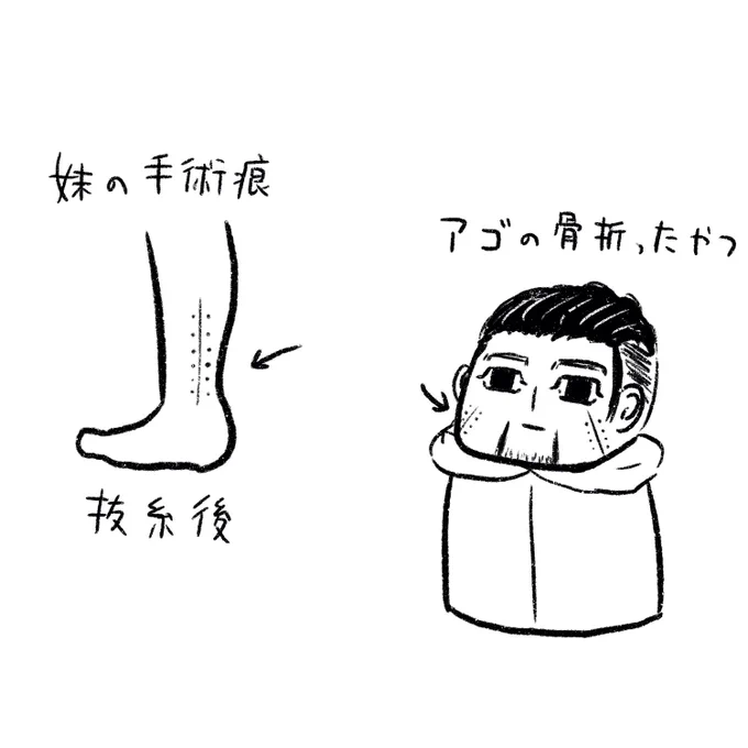 妹「骨折したとこの抜糸したんだけどさぁ」
私「(うわぁ聞くだけで痛いやつ)」
妹「尾形と同じ傷痕できた」
私「見せて」 