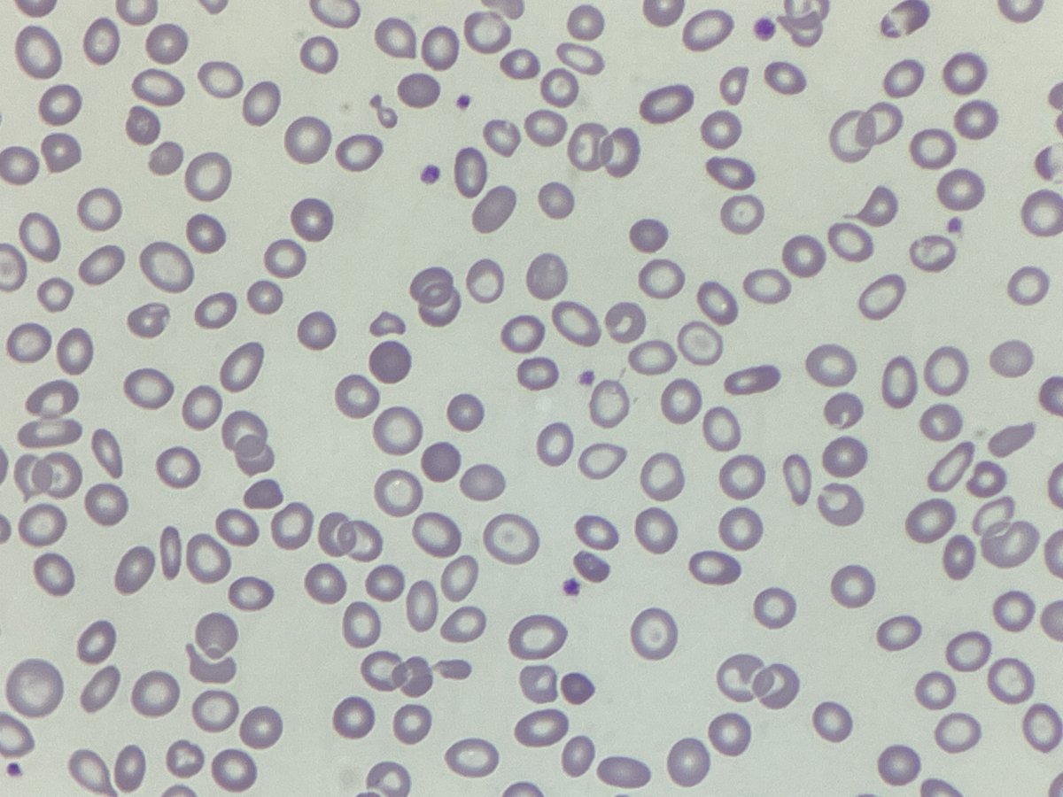 #MorphologyMonday

A sample pops onto the haematology authorisation queue. The FBC results are:

WBC: 7.09
RBC: 4.57
HB: 62
MCV: 49.9
MCH: 13.6
MCHC: 272
RDW: 24.0

The clinical details state, PR bleed. What does the film show and does it match the FBC?

#OnlyCells #underthescope